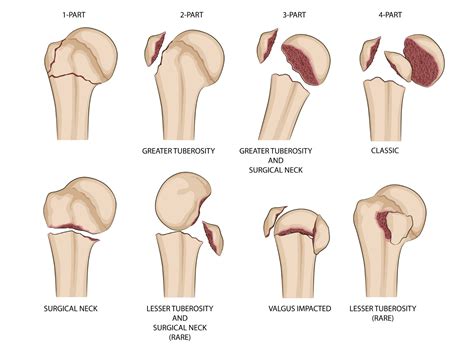 Neer Classification Of Proximal Humeral Fractures – VNUMS