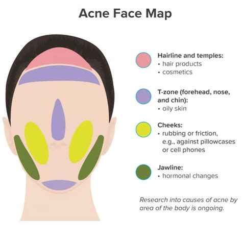Acne Face Map Sides Of Nose at Gerald Chisholm blog