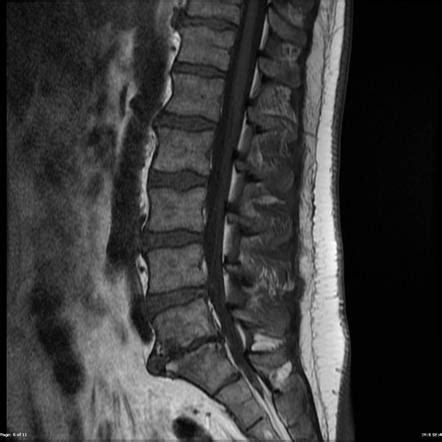 Image result for Foraminal Disc Extrusion