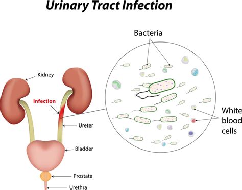 Urinary Tract Infection Treatment in Chattanooga, TN