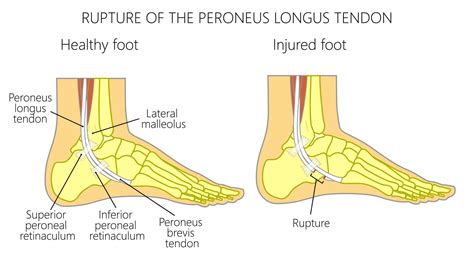 Peroneal Tendon Tear: Diagnosis, Treatment and Surgery