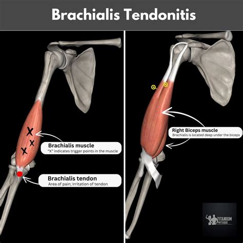 Brachialis Tendonitis: Managing Pain At Front of the Elbow