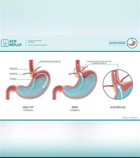 Puberty Headaches: 9 Relief And Prevention Tips For Teens