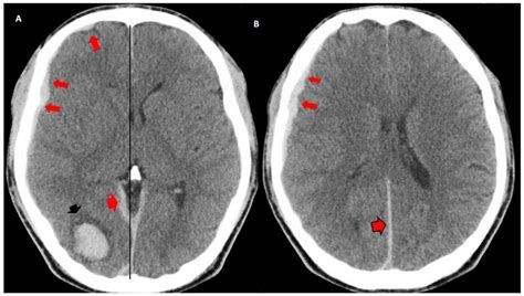 Subarachnoid Hemorrhage Ct