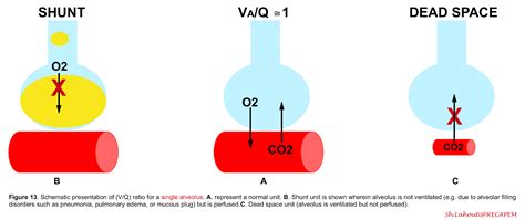 Adult Respiratory Distress: ABCs of Oxygenation and Ventilation | RECAPEM
