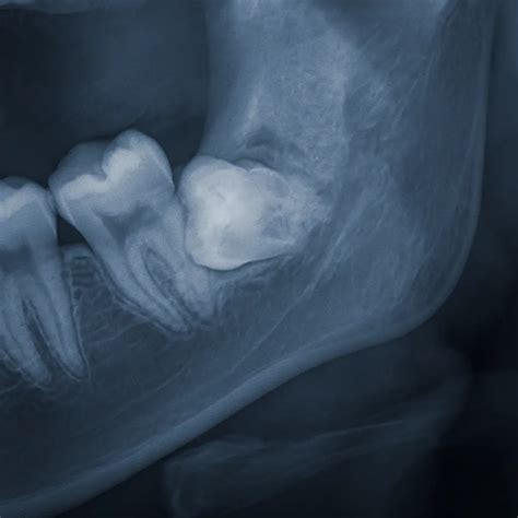 Wisdom Tooth Infection Symptoms: Signs, Risks & Treatment