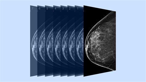 3D Mammogram: Who Needs One, What to Expect and More