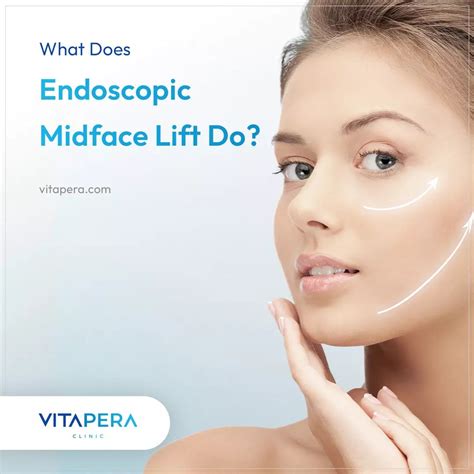 Endoscopic Facelift Turkey at Nicole Humphreys blog