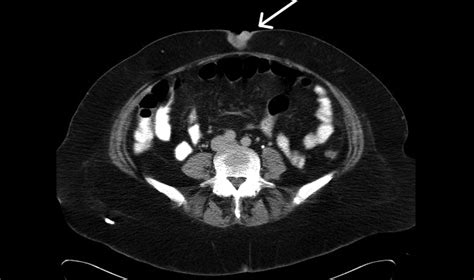 Sister Mary Joseph's nodule | CMAJ