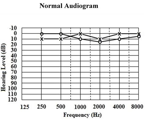 Audiogram Types and examples 的图像结果