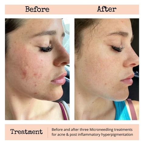 Acne Scars Look Worse After Microneedling at Jett Duryea blog