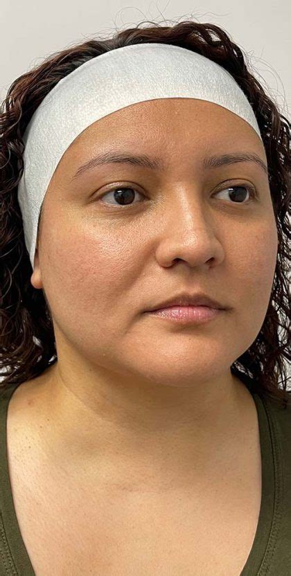 Patient #11065 Thread Lift Before and After Photos Brea - Med Spa Gallery Costa Mesa - Skin ...