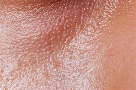 Methods to properly remove blackheads