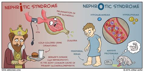 Image result for nephrotic syndrome | Nephritic syndrome, Nephrotic ...
