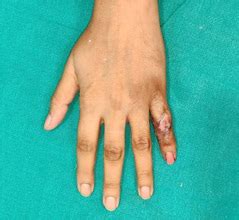 Amputation Prevention Center in Noida | Amputation Prevention Treatment ...