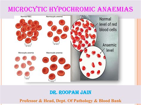 Microcytic Hypochromic Anaemias, Iron Deficiency Anaemia | PPT