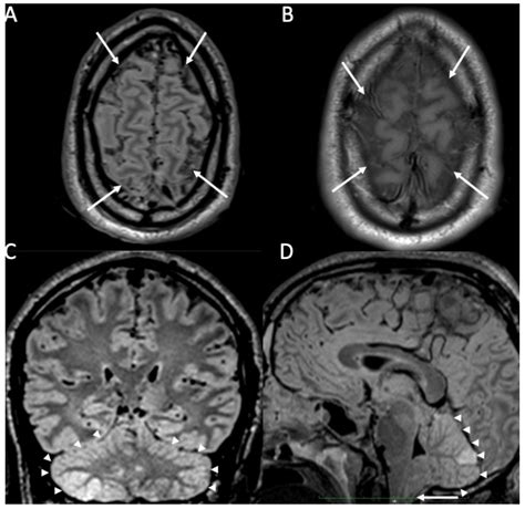 Neuroimaging of the Most Common Meningitis and Encephalitis of Adults ...