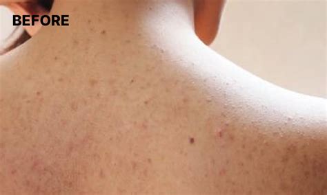 Salicylic Acid Body Wash for Acne & Exfoliation - Chemist At Play ...