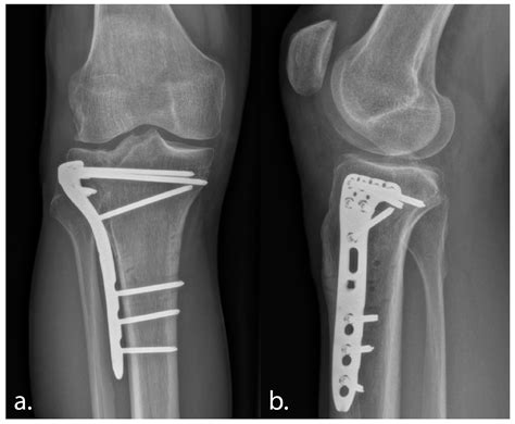 The Panflute Technique: Novel 3D-Printed Patient Specific ...