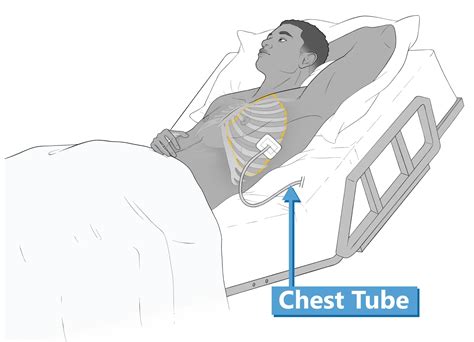 Nursing Diagnosis For Patient With Chest Tube | Detroit Chinatown