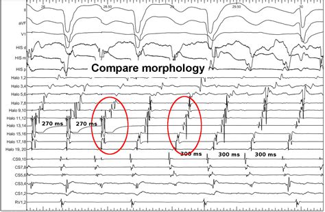 Mapping fundamentals, electrograms and entrainment