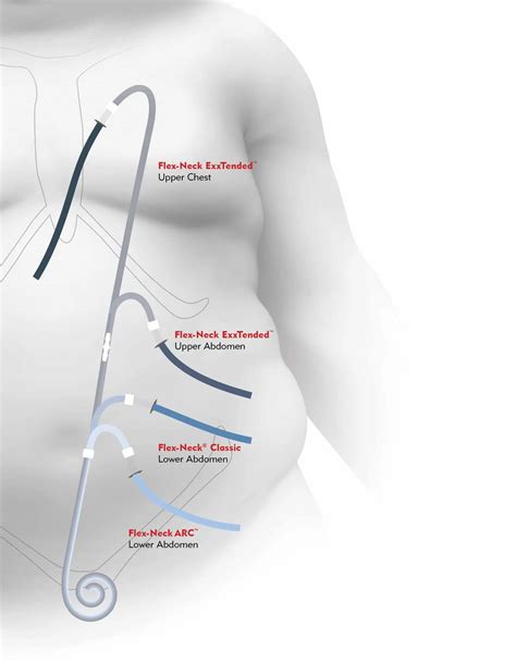 Peritoneal Dialysis Catheter Kit For Hospital Id