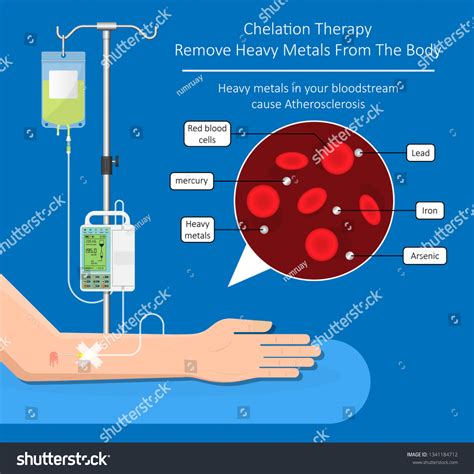 18 Chelation Blood Vessel Images, Stock Photos & Vectors | Shutterstock