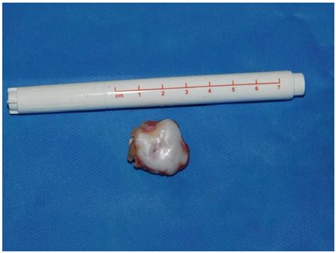 Arthroscopic Excision of Scapular Exostoses: A Technical Note
