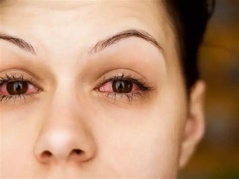 5 eye symptoms that may reveal hidden heart trouble - Eyes as a cardio ...