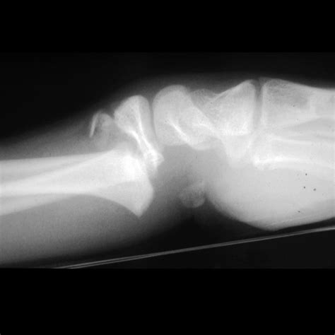 Salter-Harris Fracture | Pediatric Radiology Reference Article | Pediatric Imaging | @pedsimaging