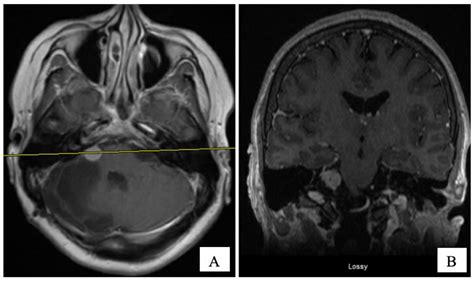 CSF Rhinorrhea: A Rare Clinical Presentation of Choroid Plexus Papilloma