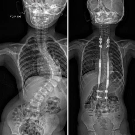 Scoliosis X Ray With Rods