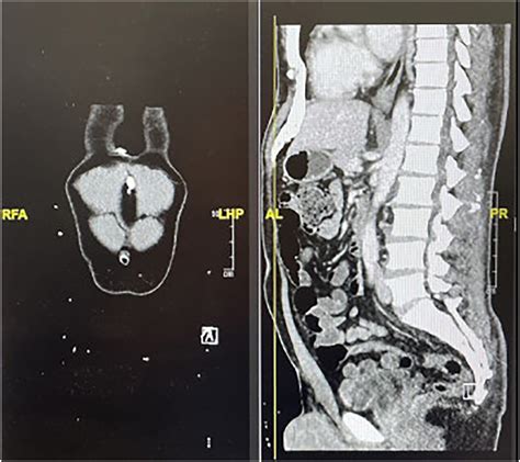 Postoperative Exostosis: Ectopic Ossification After Pericardial Window Procedure - Annals of ...