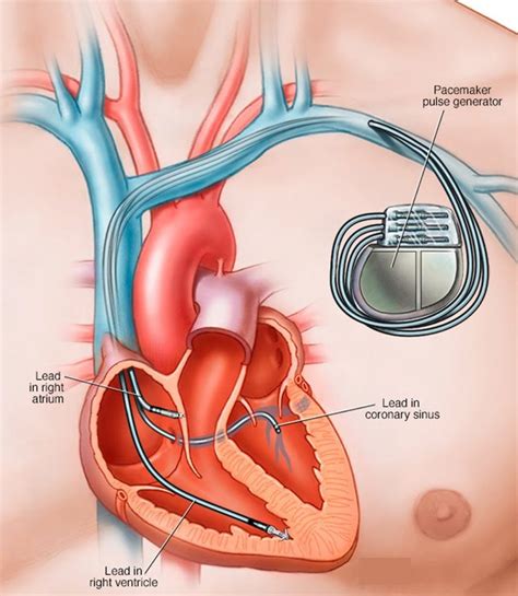 Pacemaker Procedure 的图像结果