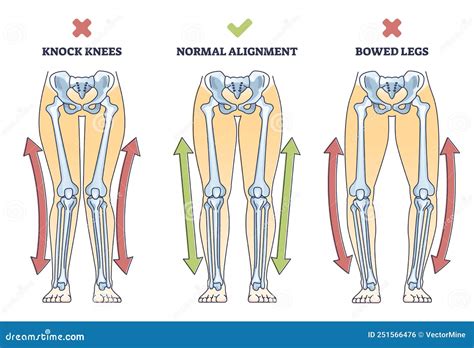 Medical Term For Knock Knee at Declan Thwaites blog