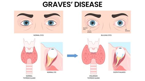 Thyroid Eye Disease: Causes, Symptoms & Expert Care