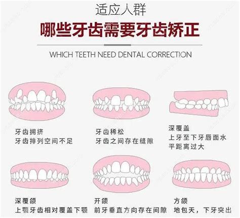 矫正过程中牙齿松动正常吗?正常,矫正完成后会自己恢复哦 - 口腔资讯 - 牙齿矫正网