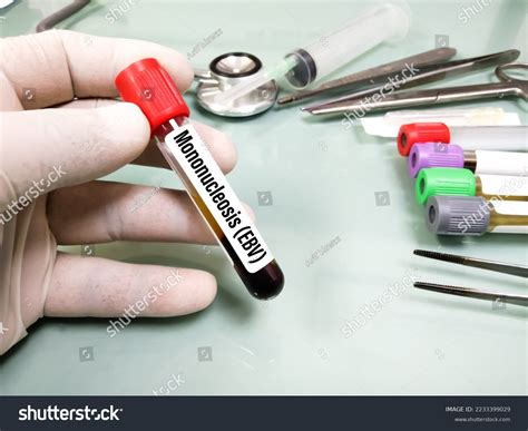 781 Mononucleosis Images, Stock Photos & Vectors | Shutterstock