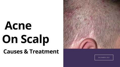 What Causes Scalp Acne And Hair Loss at Laura Stanley blog