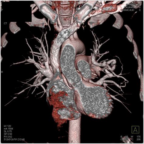 Pulmonary Arteriovenous Malformation