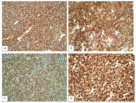 Low-Grade Primary Splenic CD10-Positive Small B-Cell Lymphoma ...