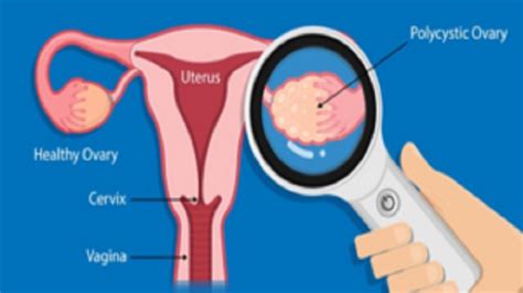 World ovarian cancer day 2025, here's all you need to know about it
