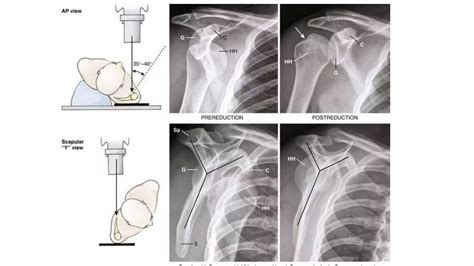 Image result for Shoulder Reduction Methods