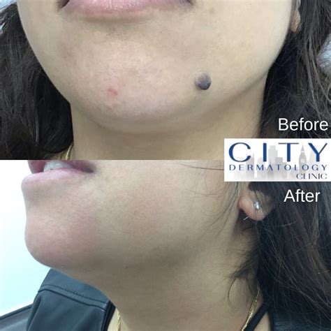 Before and After Photos Mole Removals