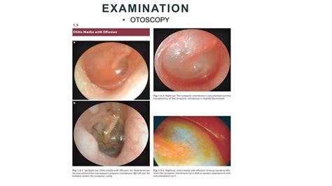 Serous Otitis media and Grommets | PPTX