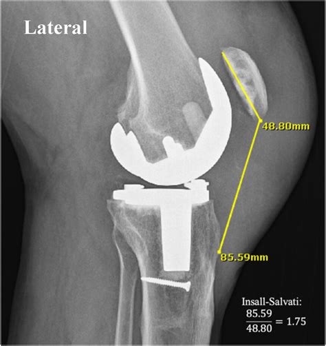Reconstruction of a Chronic Ruptured Patellar Tendon With Achilles ...