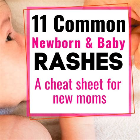 What To Use On Baby Rash Under Neck at Dorothy Brogan blog