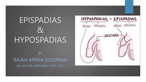 HYPOSPADIAS & EPISPADIAS.pptx