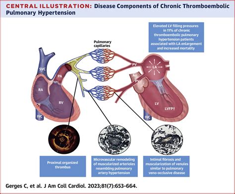 Pulmonary Arterial Resistance
