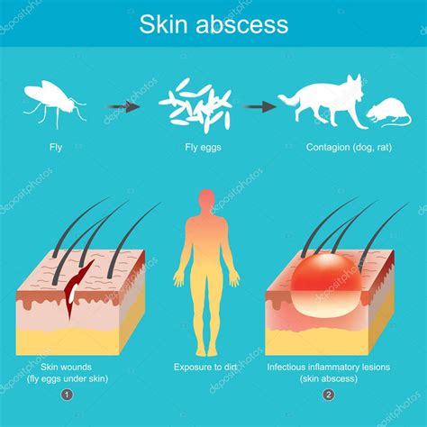 Absceso cutáneo . Vector de Stock de ©pattarawit 305863372